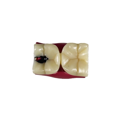 Стоматологическая модель зуба с кариесом и здоровым зубом Corpo Caries-3