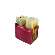 Стоматологическая модель зуба с кариесом и здоровым зубом Corpo Caries