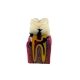 Стоматологическая модель зуба с кариесом и здоровым зубом Corpo Caries